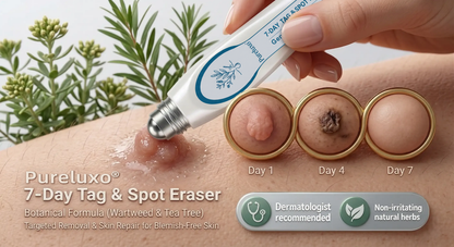 Quillanco® Skin Tag Remover Roller🌟🏆