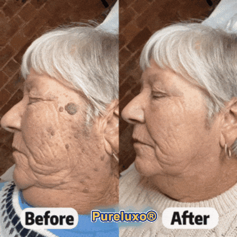 Quillanco® Skin Tag Remover Roller🌟🏆