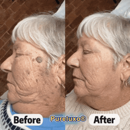 Quillanco® Skin Tag Remover Roller🌟🏆