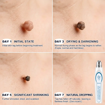 Quillanco® Skin Tag Remover Roller🌟🏆